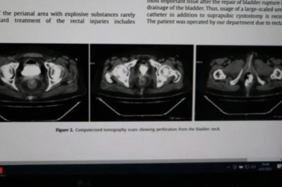 Denizli'de Makatına Torpil Yerleştirip Patlatan Kişi, Tıp Literatürüne Girdi